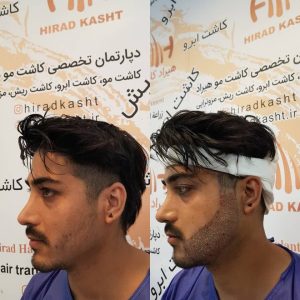 کاشت مو هیرادکاشت کاشت مو ابرو ریش در پاسداران 11 1