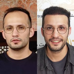 کاشت مو هیرادکاشت کاشت مو ابرو ریش در پاسداران 3 1
