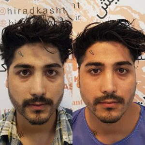 کاشت مو هیرادکاشت کاشت مو ابرو ریش در پاسداران 4 1