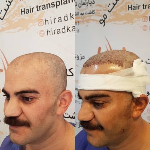 کاشت مو هیرادکاشت کاشت مو ابرو ریش در پاسداران 6 1