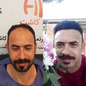 کاشت مو هیرادکاشت کاشت مو ابرو ریش در پاسداران 7 1