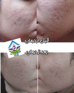 جادو طبیعت سبز خدمات تخصصی رفع جوش و لک و اسکالپ در قم گلزار شهدا 19