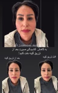 بیوتی لند تزریق چربی ژل بوتاکس لیزر موهای زائد تخلیه چربی در تهران پاسداران 6 2 1 1 1