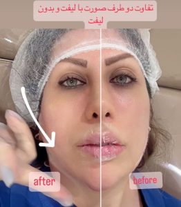 بیوتی لند تزریق چربی ژل بوتاکس لیزر موهای زائد تخلیه چربی در تهران پاسداران 9 2 1 1 1